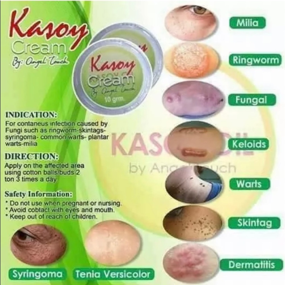 Kasoy Cream by Angel Touch skin tag keloid milia